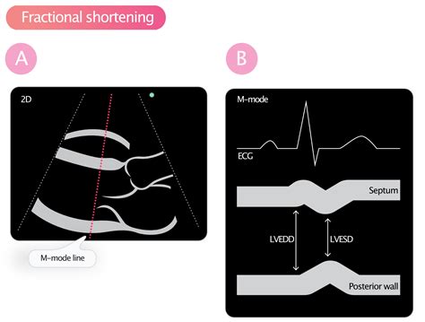 fractional shortening echo normal range.